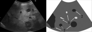 Гипоэхогенное образование печени