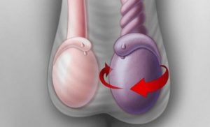В мошонке левое яичко ниже правого