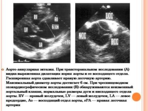 Расширение аорты на уровне синусов Вальсальвы