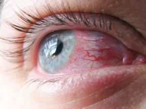 На спайке конъюнктивы глаза воспалительный очаг под слизистой