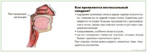 Постназальный затек