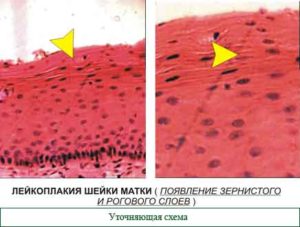 Лейкоплакия шейки матки