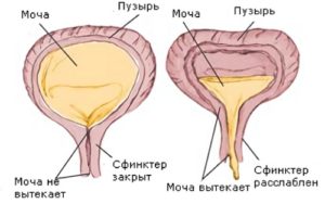 Растяжение мочевого пузыря из за передержания мочи