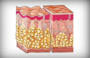 Утолщение жировой клетчатки