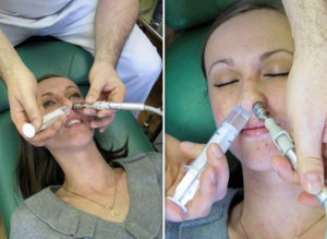 Промывание носа после операции