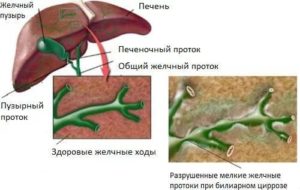 Крапивница, паразиты, уплотнение желчных протоков в печени