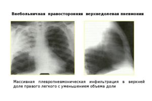 Верхнедолевая правосторонняя пневмония