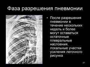 Нижнедолевая пневмония в стадии неполного разрешения