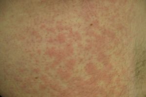 Аллергия на перьевую подушку