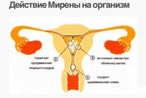 Мирена Частые и обильные месячные