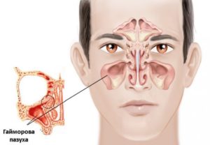 Катаральные изменения гайморовых пазух