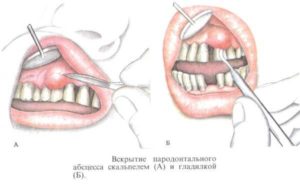 Образовалась шишка на десне после удаления зуба мудрости