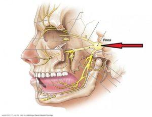 Неврит лицевого нерва после удаления зуба