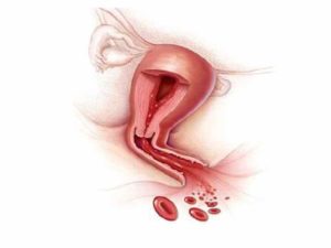 Кровотечение перед месячными во время секса