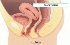 Остатки спермы в мочеиспускательном канале
