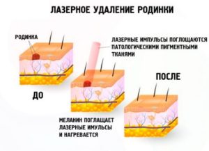 Анализы для удаления родинки