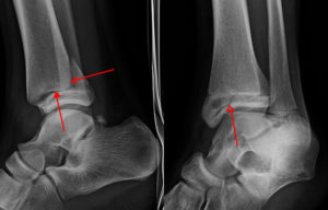 Перелом лодыжки рентген