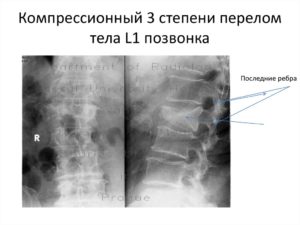 Перелом компрессионный 1-2 степени 12позвонка