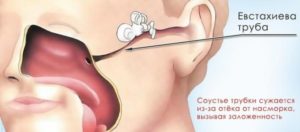 Заложенность уха после синусита