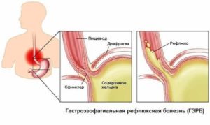 Боль в пищеводе при глотании пищи