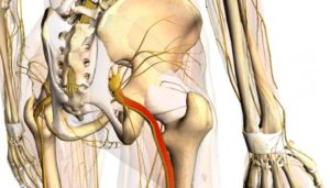 Как лечить защемление пахового нерва