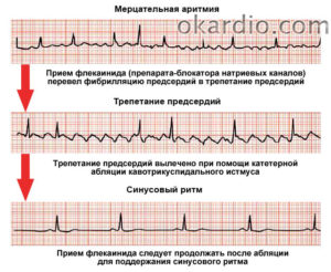 Может ли при нарушении ритма сердца, болеть голова?