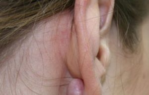 Болевой синдром за ухом возле мочки