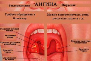 Боли в горле, отек миндалин, красные пятна