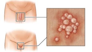 Сыпь на малых половых губах