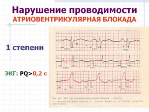 Посмотрите пожалуйста ЭКГ, замедление АВ проводимости