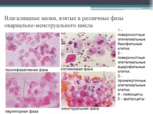 Мазки при беременности, сильно выраженное воспаление