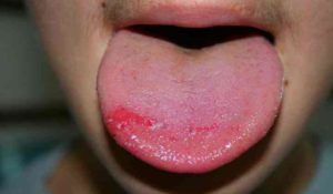 Гладкое розовое пятно на языке