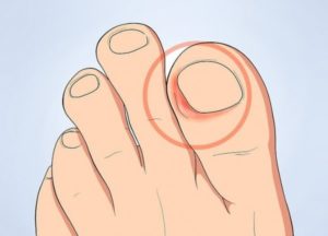 Болит ноготь второго пальца на ноге