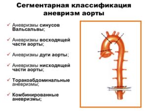 Расширение аорты на уровне синусов Вальсальвы