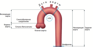 Расширение аорты на уровне синусов Вальсальвы