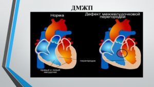 Дефект межжелудочковой перегородки у плода