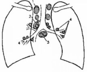 Внутригрудные лимфатические узлы, очаги в легких