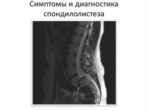 Операция при диско остеофитном комплексе