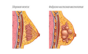 Об установке спирали Мирена при фиброзно-кистозной мастопатии