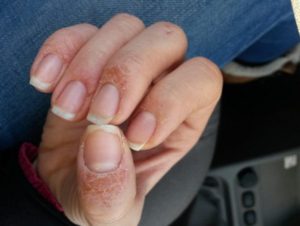 После наращивания ногтей чешутся пальцы