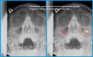 Инфильтративно-воспалительные изменения слизистой обеих верхнечелестной пазухи носа