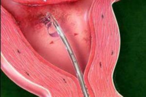 Пайпель биопсия эндометрия