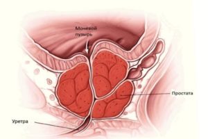 Боль после массажа простаты