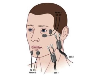 Операция или физиотерапия при неврите лицевого нерва