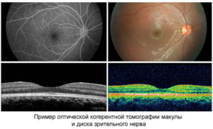 ОСТ макулы и сетчатки