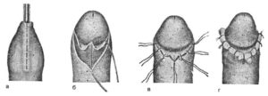 Головка полового члена перестала полностью закрываться