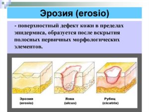 Эрозии на коже