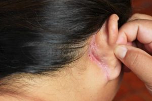 Мокнущие кроваточащие раны за ушами у ребенка 4,5 лет