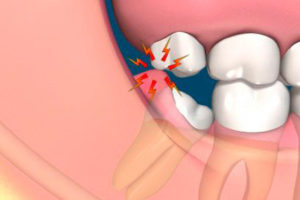 Лезет зуб мудрости, больно открывать рот