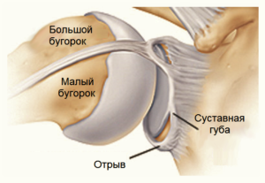 Повреждения передних отделов суставной фиброзно-хрящевой губы гленоида